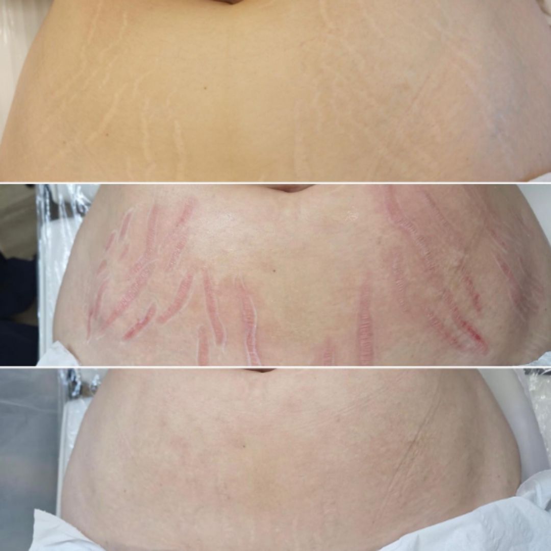 inkless stretch marks needling treatment results