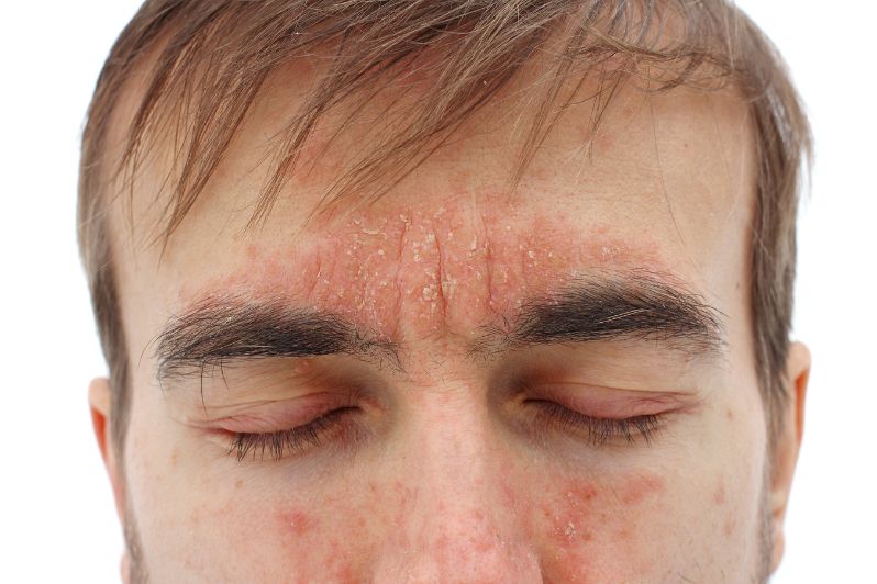 man with peeling psoriasis on face