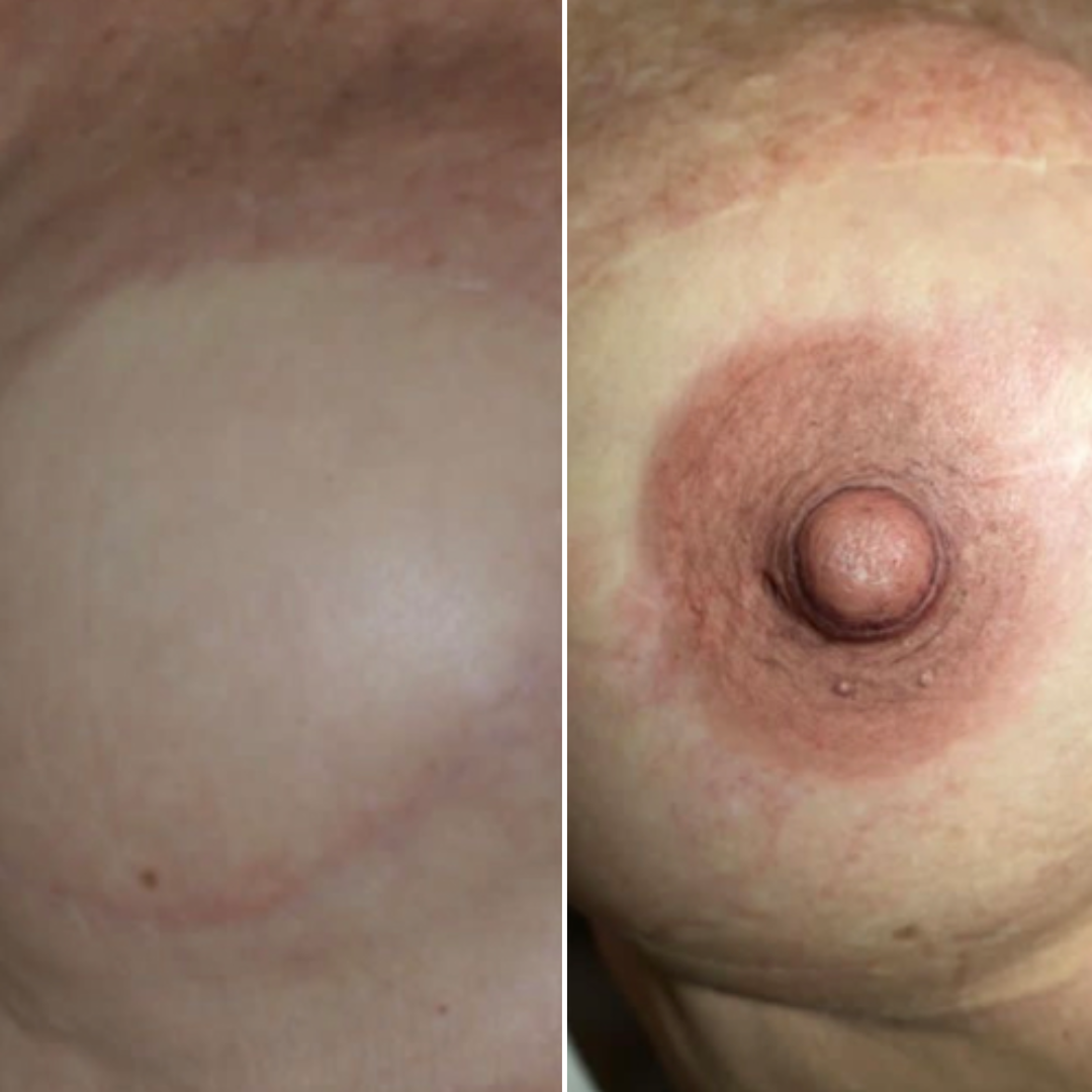 3D Nipple & Areola Micropigmentation