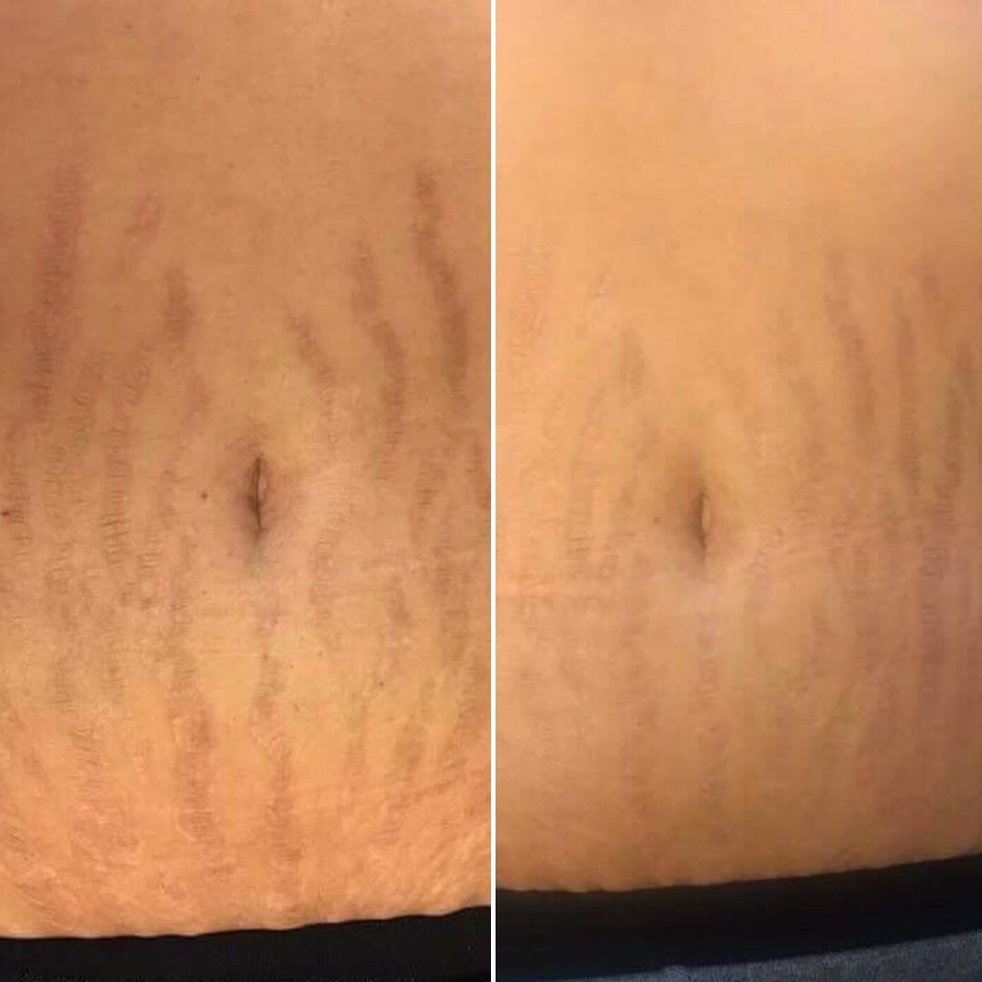 Stretch Marks Treatment Before & After