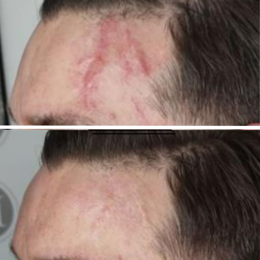 Before and after Medical Needling