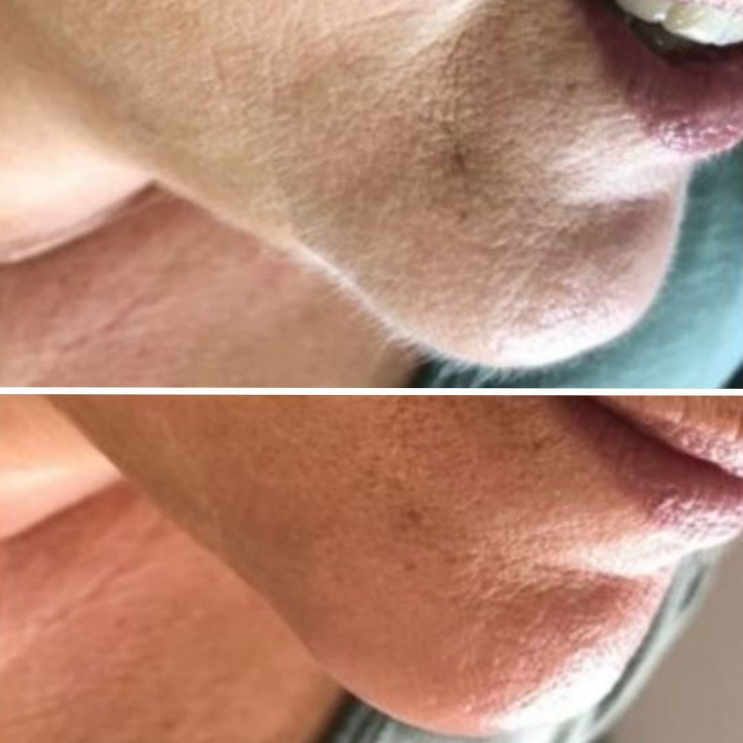 Before and after results for Dermaplaning treatment