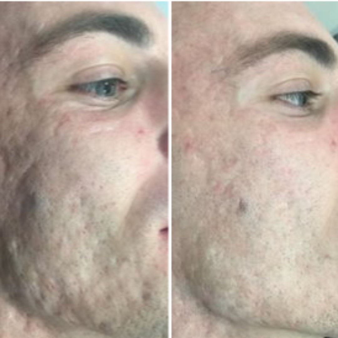 Acne scarring before and after medical needling