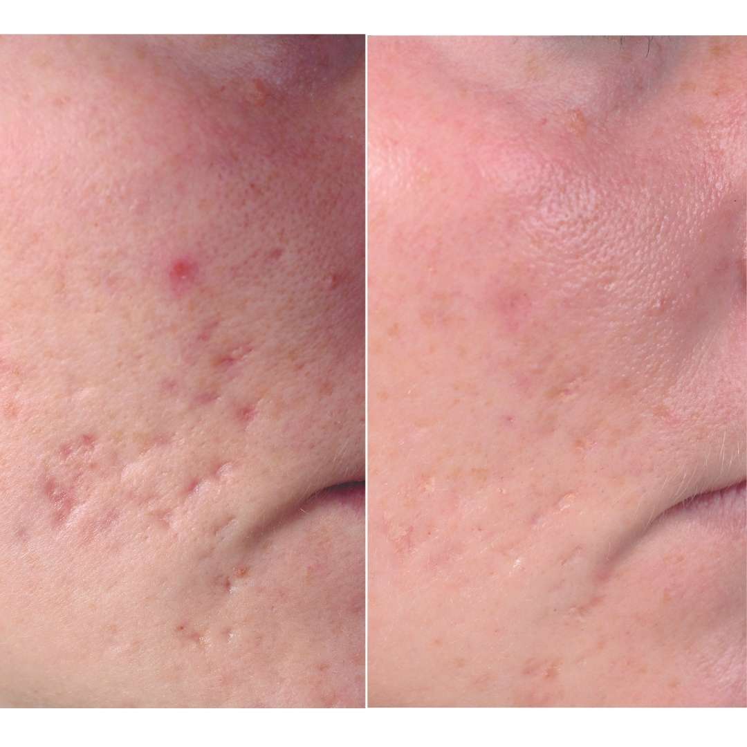 Before and after acne scarring microneedling treatment
