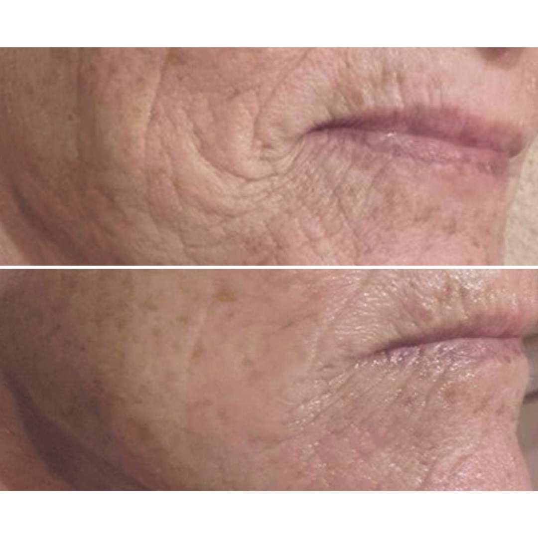 Before and after Meso+ microneedling treatment for lines and wrinkles