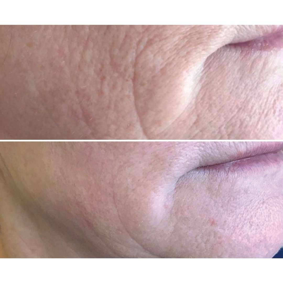 Skin needling before & after