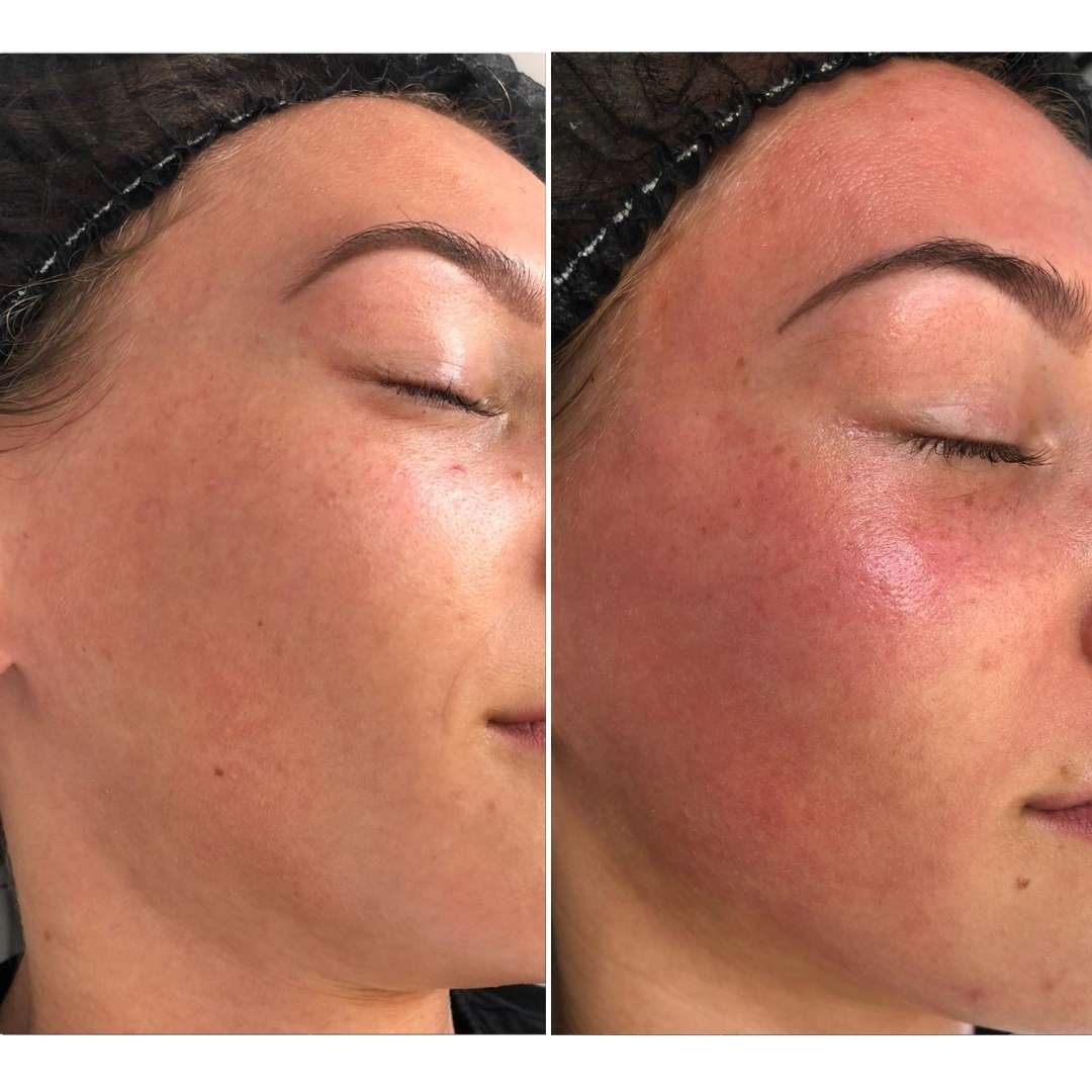Before and after gentle microneedling & peel