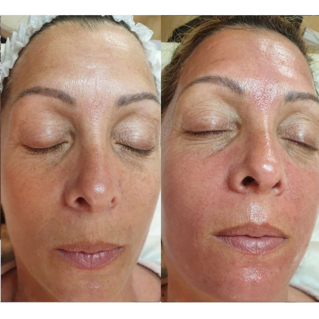 results from non-invasive microneedling facial