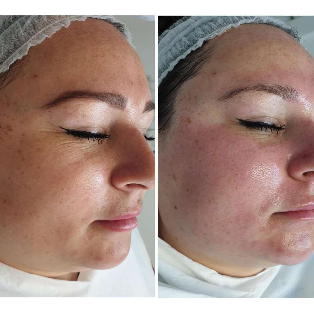 Non-invasive microneedling before and after