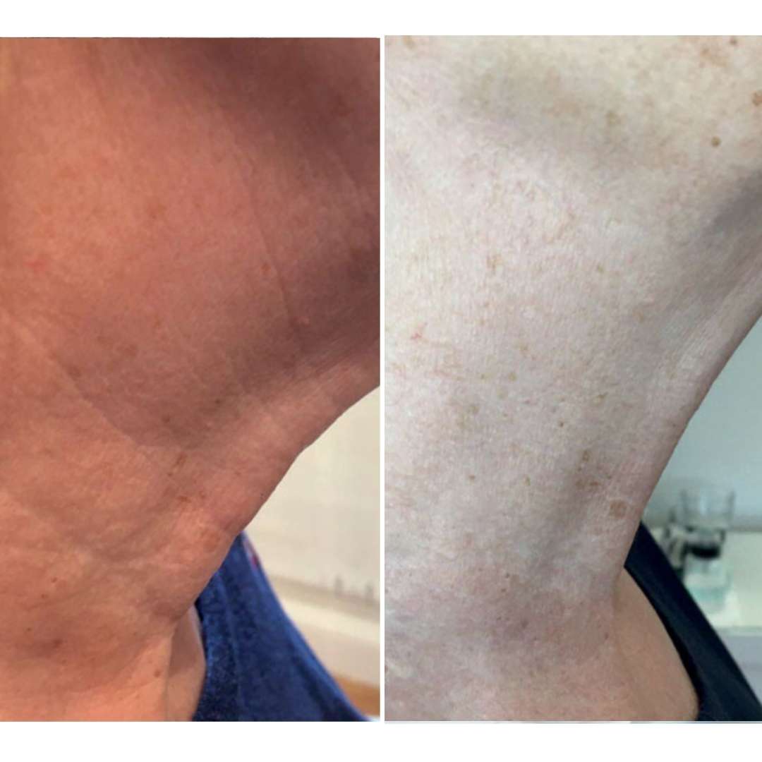 Before and after Fibroblast Plasma Pen Skin Lifting & Tightening treatment