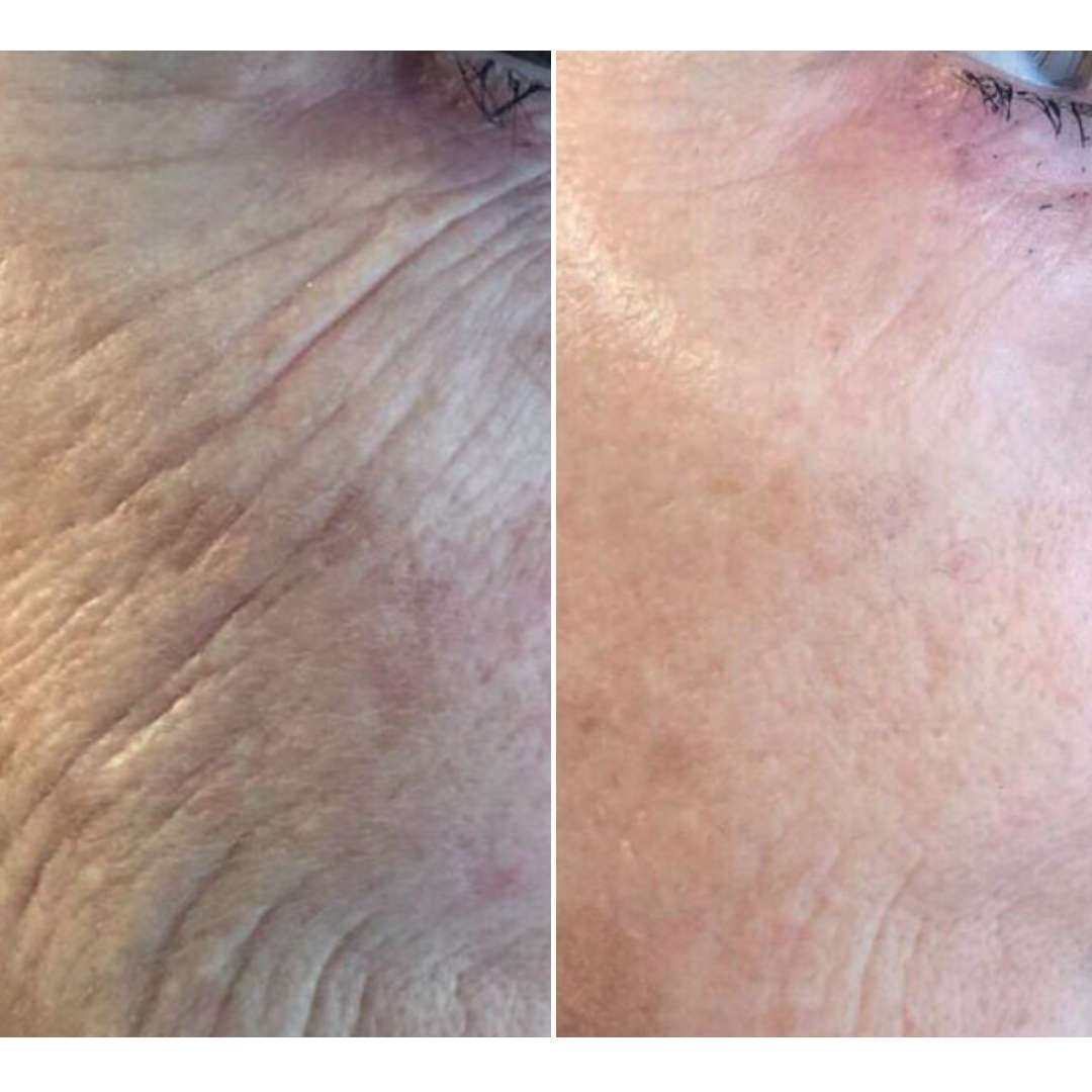 Before and after Fibroblast Plasma Pen Skin Tightening treatment