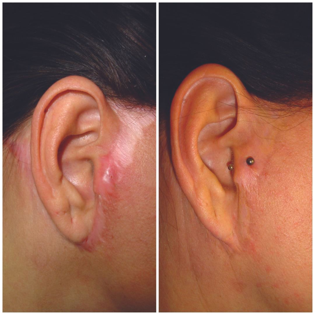 Scar around ears before and after