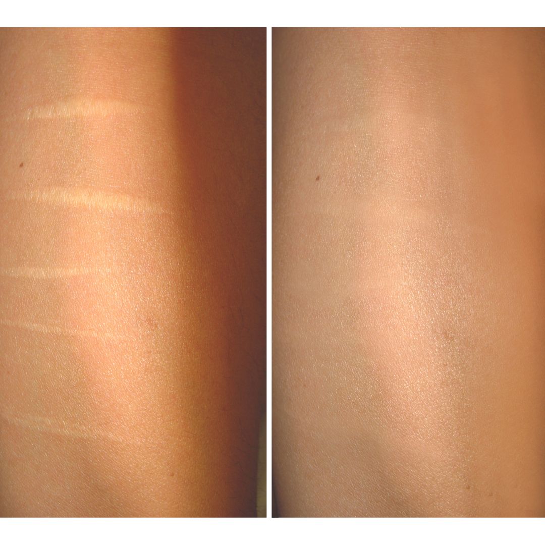Before and after self harm scar reduction treatment