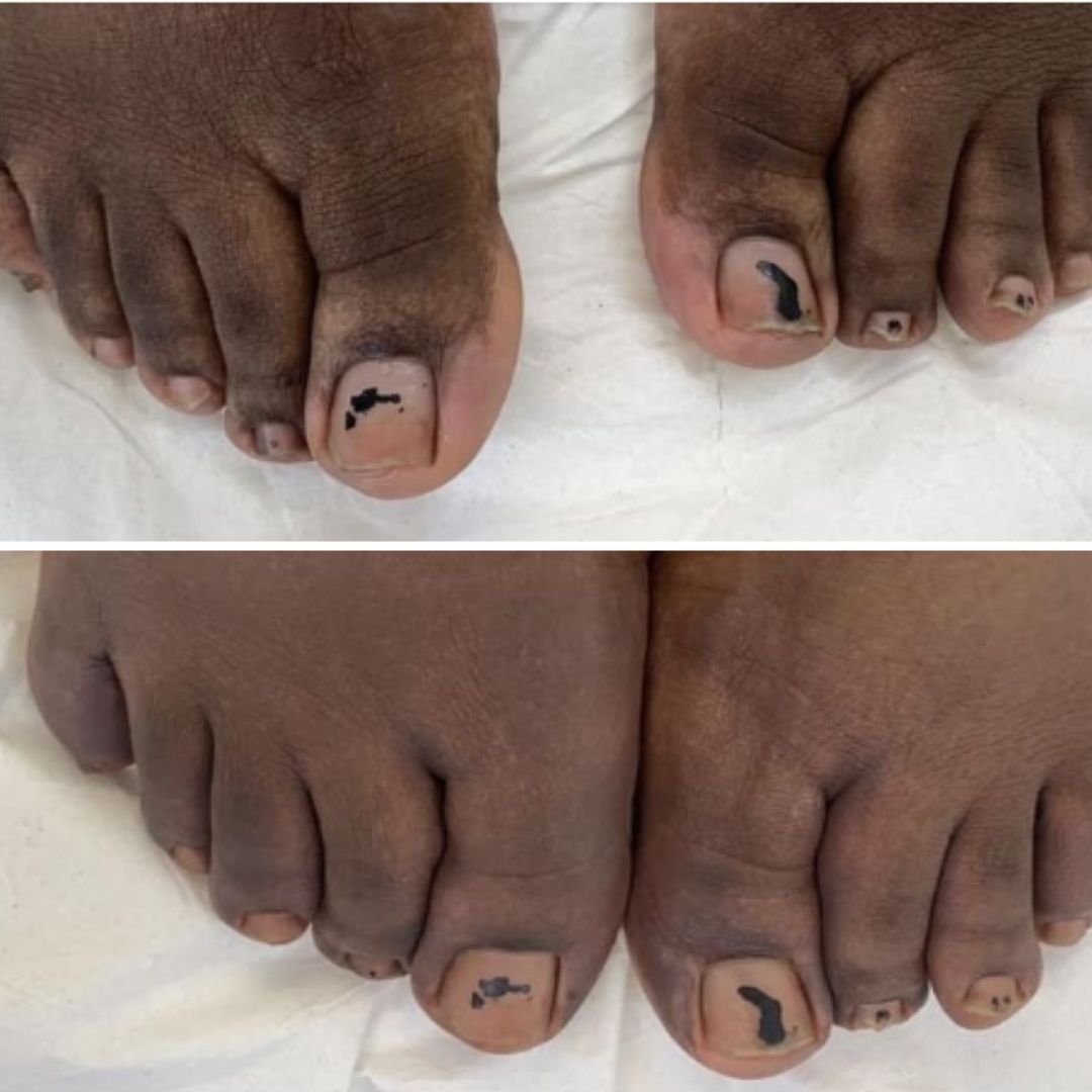 Vitiligo on feet camouflage treatment results