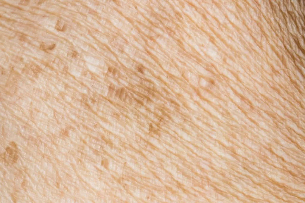 Find out what is hyperpigmentation and why it happens 