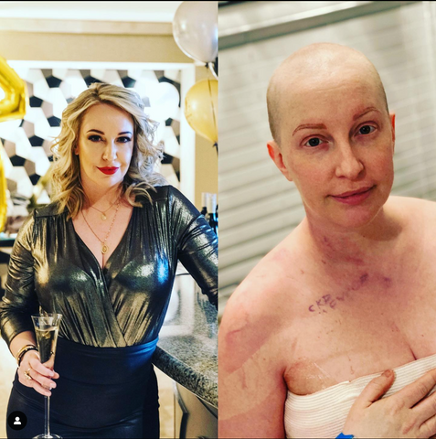 image of breast cancer before and after