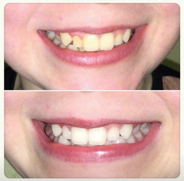 ap 24 toothpaste before and after