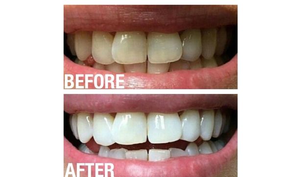 ap 24 toothpaste before and after