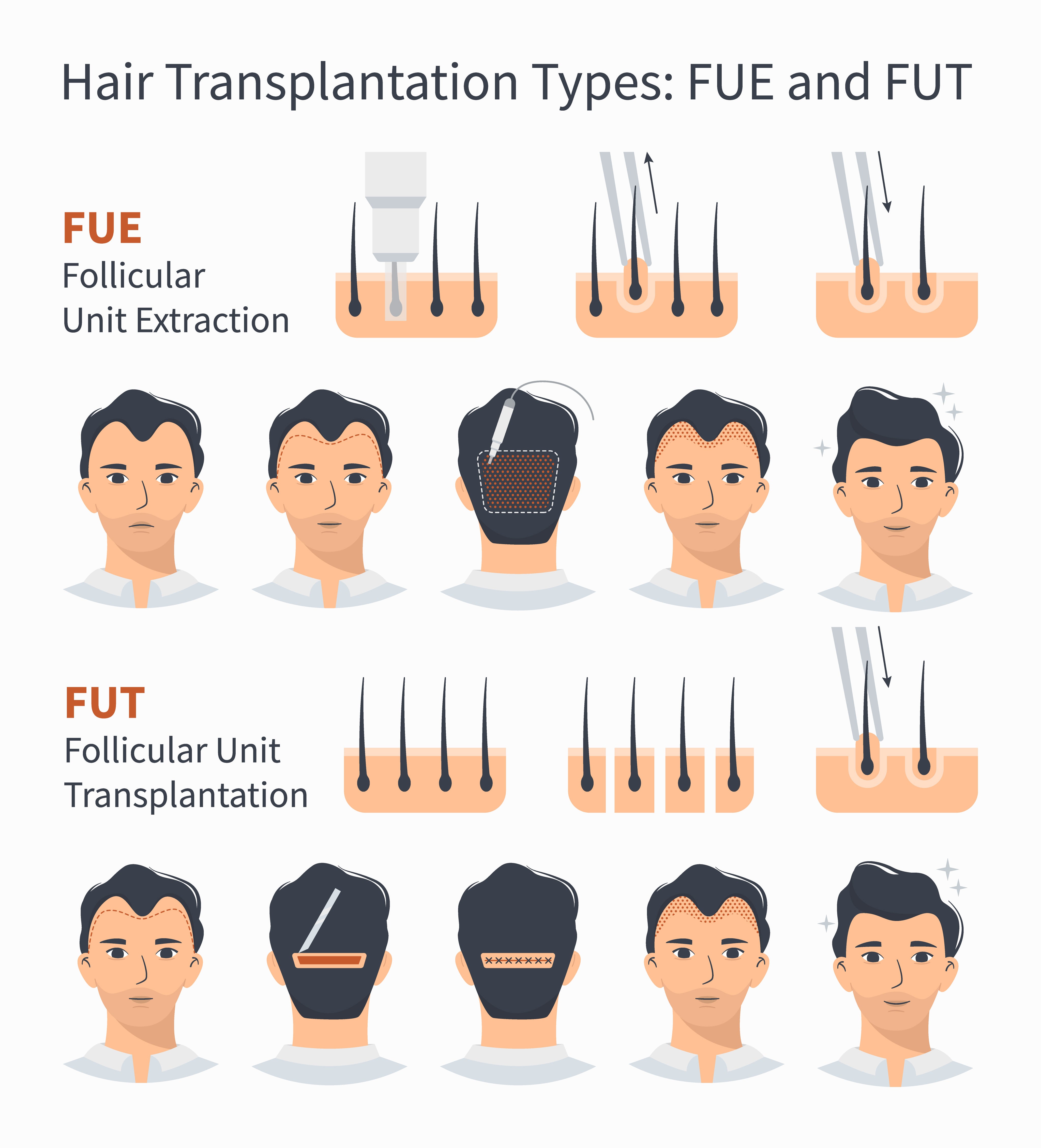 Surgical Treatments (Hair Transplantation)