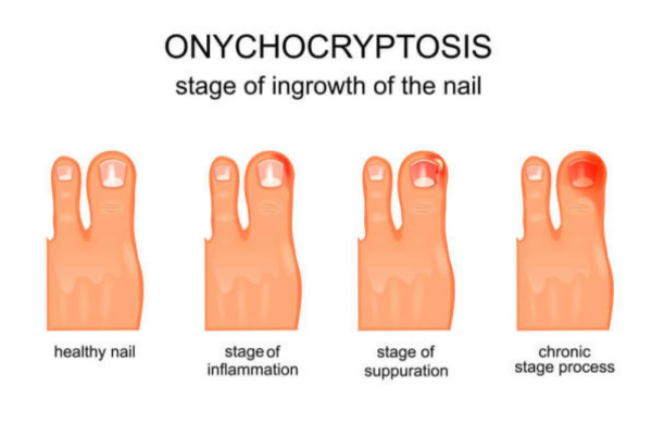 cuticle nippers for ingrown toenails