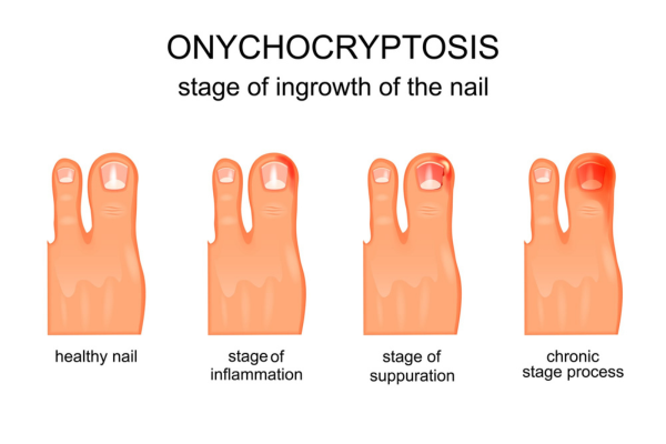 The growth process