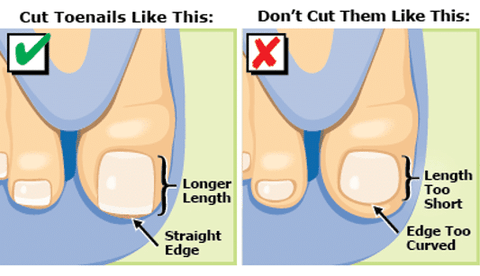 Softening the toenail