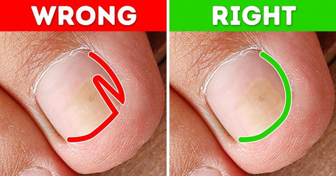 Mistakes to avoid when cutting ingrown toenails