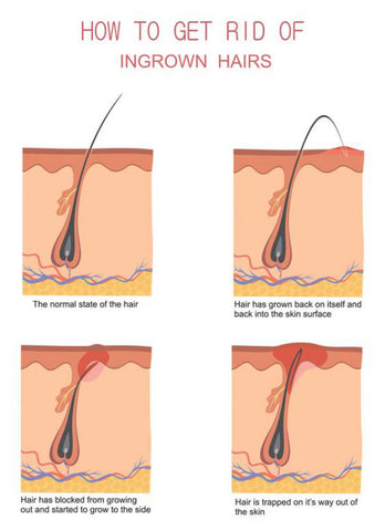 Differentiating ingrown hairs from other issues