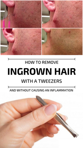 Ingrown Hair Removal Techniques