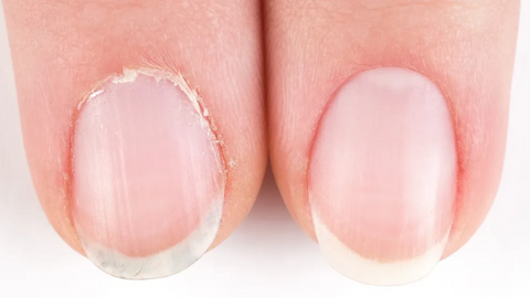 treating overgrown cuticles