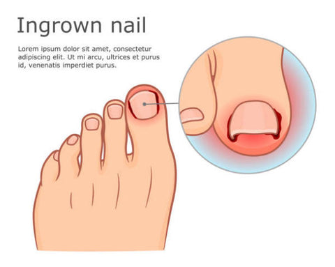 overgrown toenails