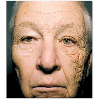Chauffeur de camion avec des dommages causés par le soleil sur un côté de son visage.