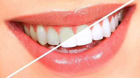 Kit de Clareamento Dental com luz de Led 10 Peças - Perfect Smile