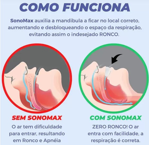 Aparelho Bocal Para Acabar com o Ronco, Apnéia e Bruxismo - SonoMax Original®