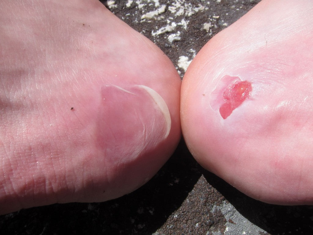 Blisters