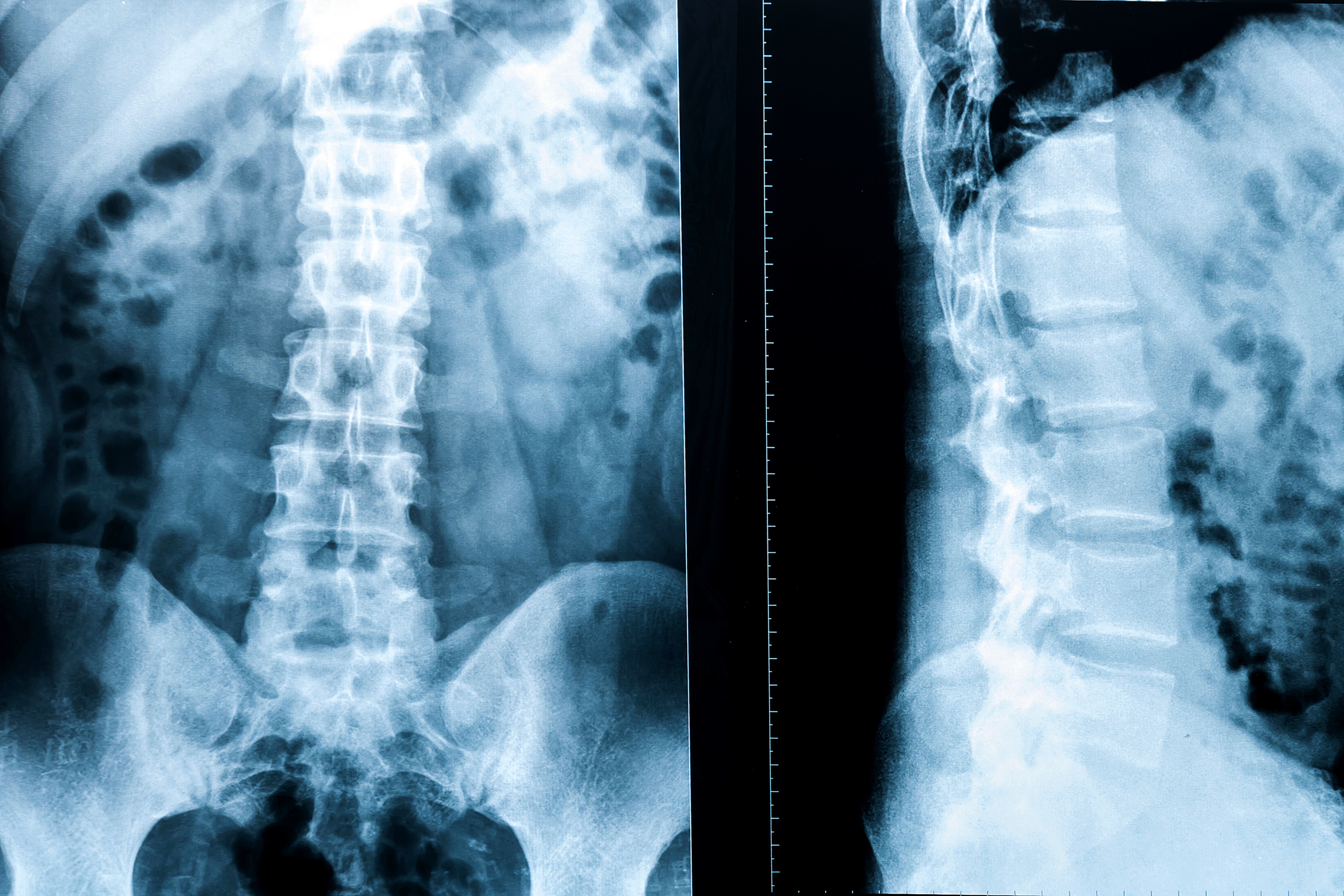  X-ray depicting the spine