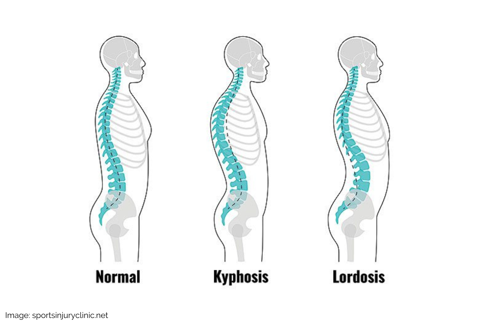 A graphic that depicts cervical hyperlordosis and lumbar hyperlordosis