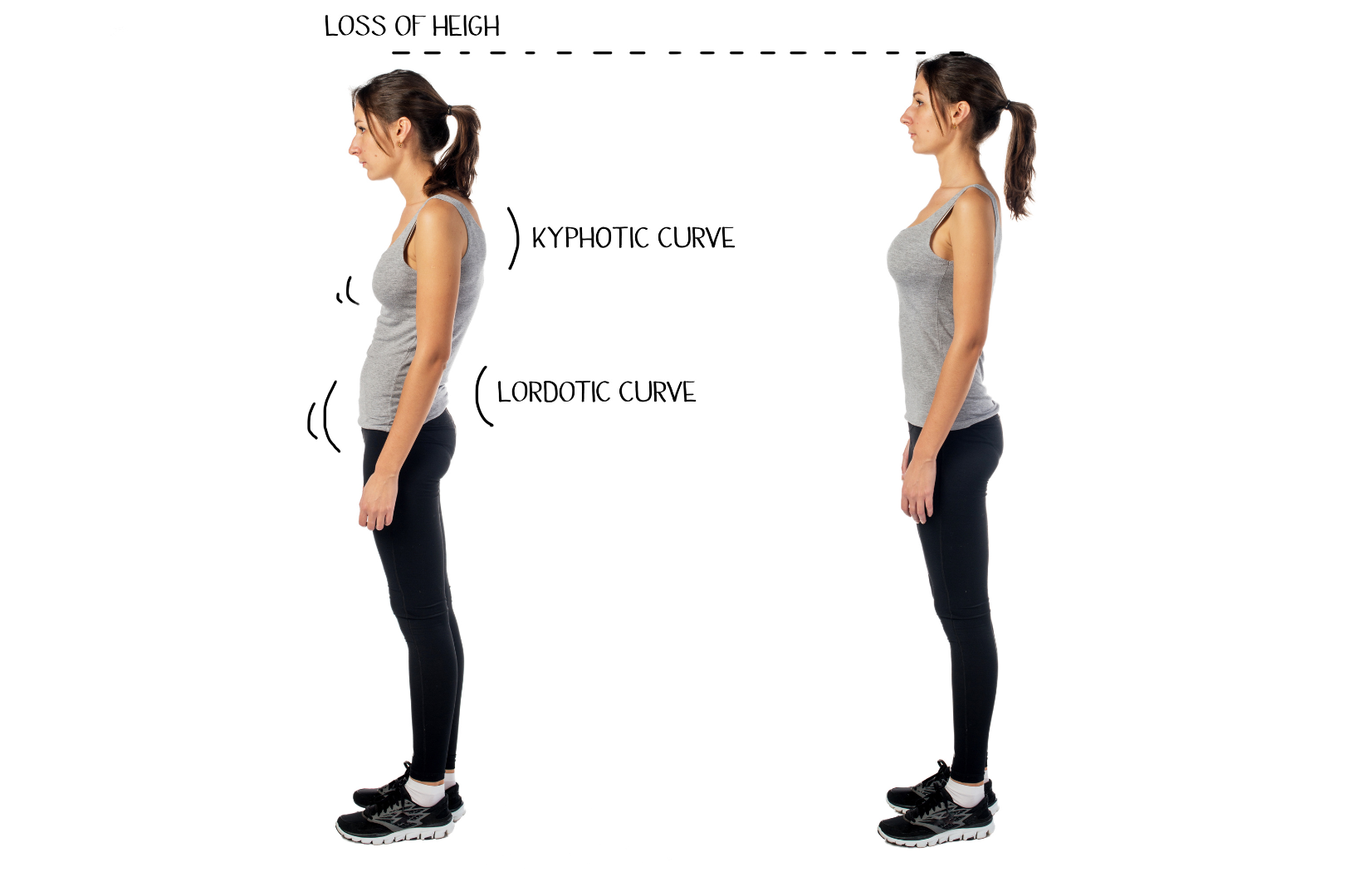 Someone standing with rounded shoulders – “mom posture”
