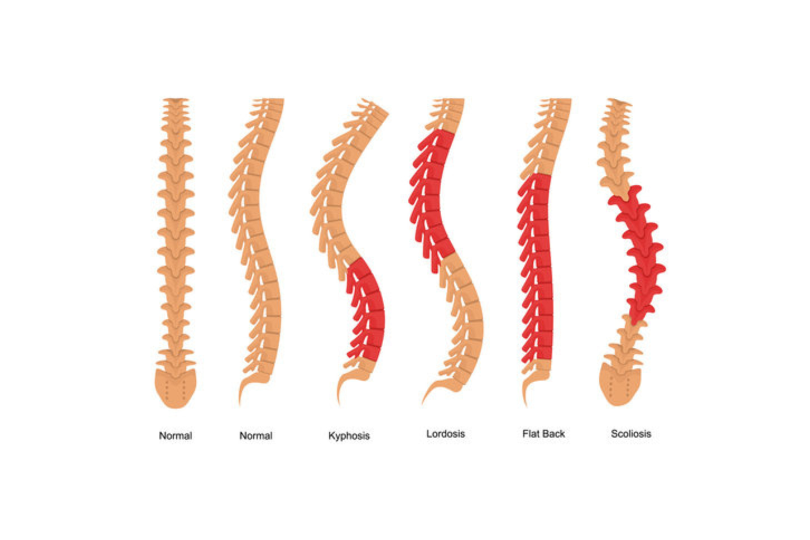  A graphic that compares hyperlordosis to kyphosis to scoliosis (could add hypolordosis as well)