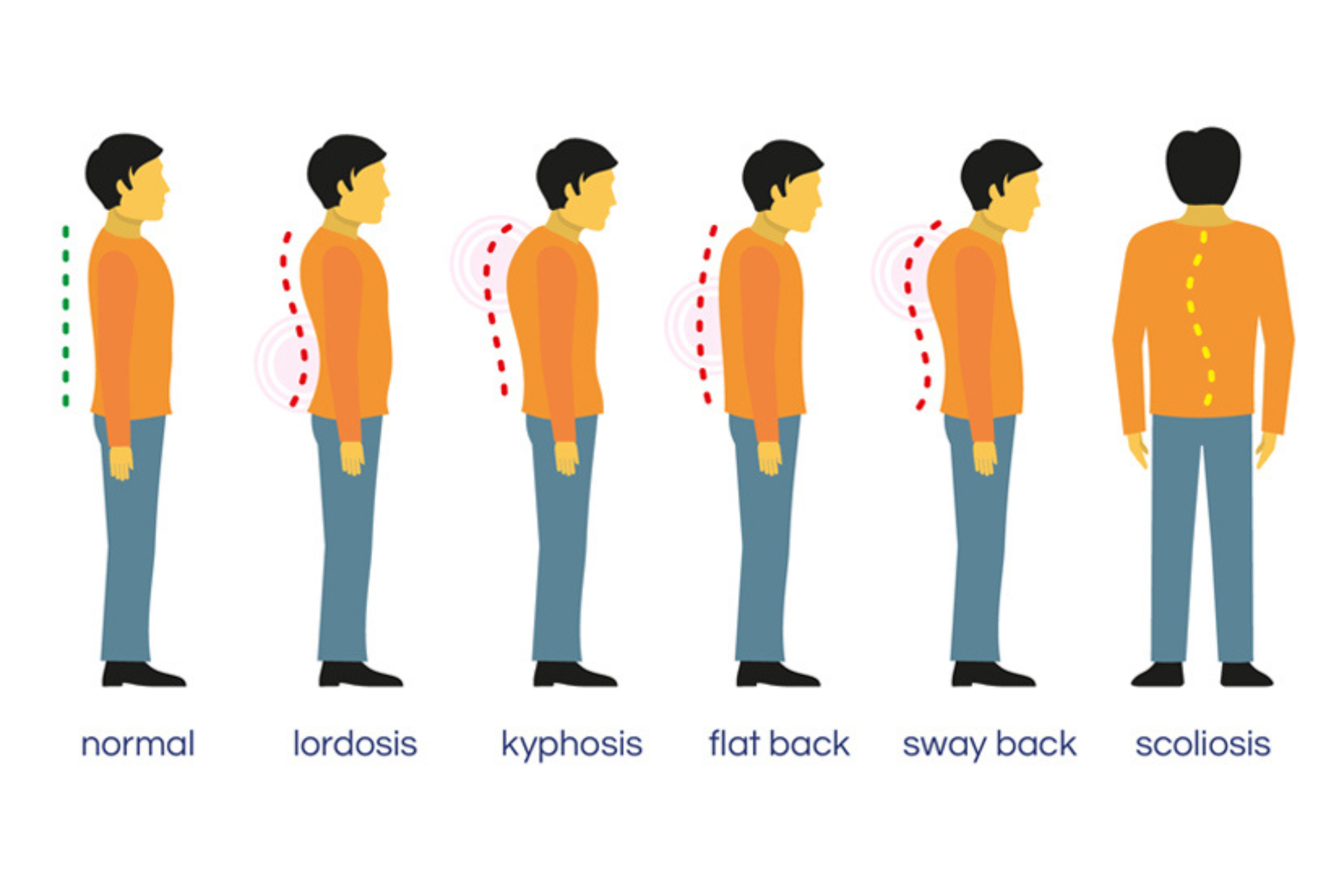 A graphic comparison of good posture to kyphosis, lordosis, forward head posture, flatback and scoliosis