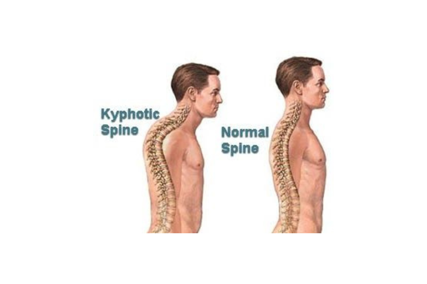 A graphic that compares a normal spine to a spine with hunchback (example: