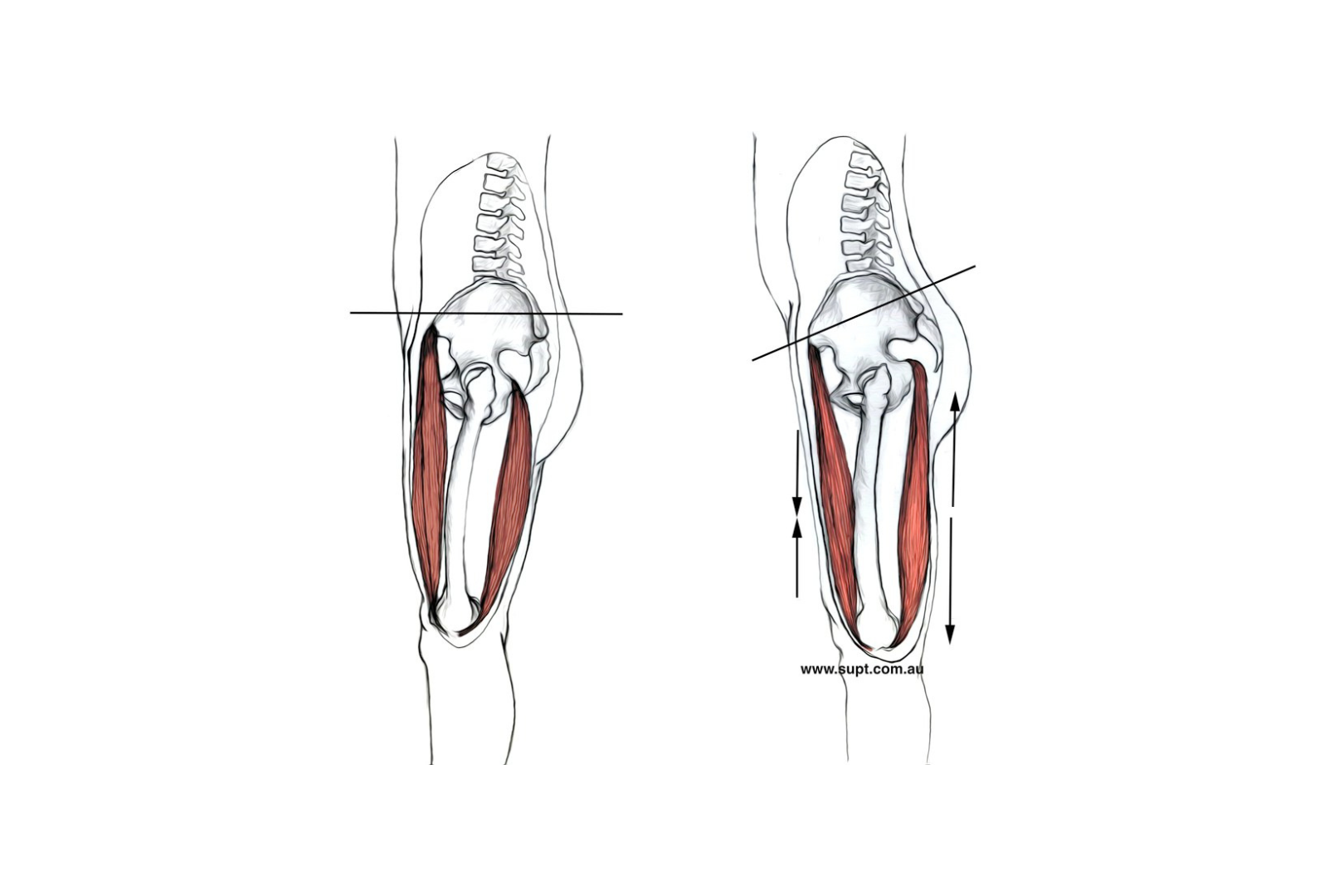 A graphic that depicts shortened hip flexors and hamstrings.