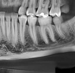 Partial dental scan of semi-arches allows considerably lower radiated dose