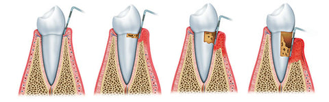 Periodontosis-1