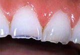 tooth erosions-1