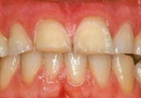 tooth erosions-2