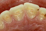 tooth erosions-3