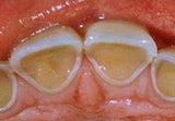 tooth erosions-4