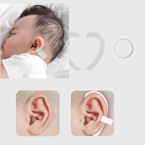 fascette per correggere orecchie a sventola neonati