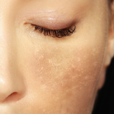 WHAT CAN BE DONE TO TACKLE DARK SPOTS?